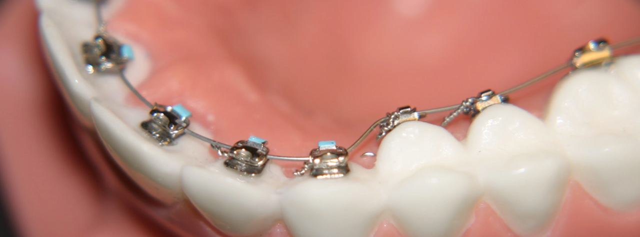 Dental Implants In Garland